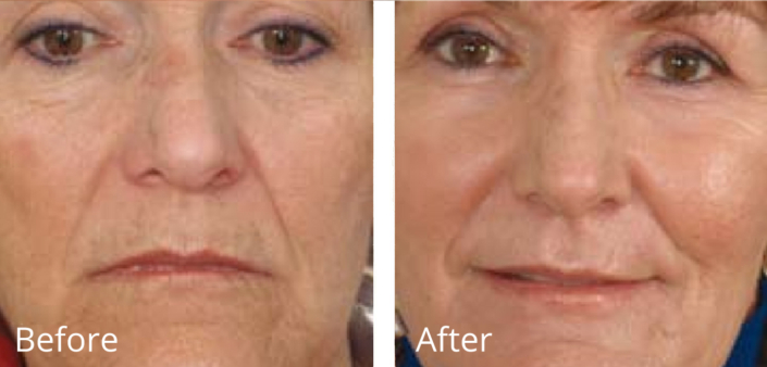 Voor- en naresultaat van lijntjes rond het oog